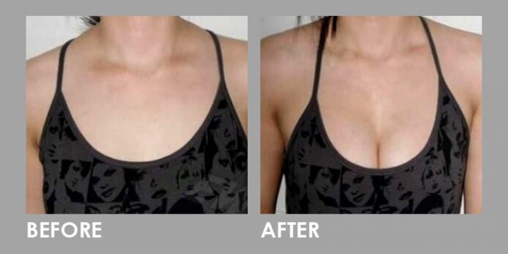 Before & After Breast Augmentation & Enlargement