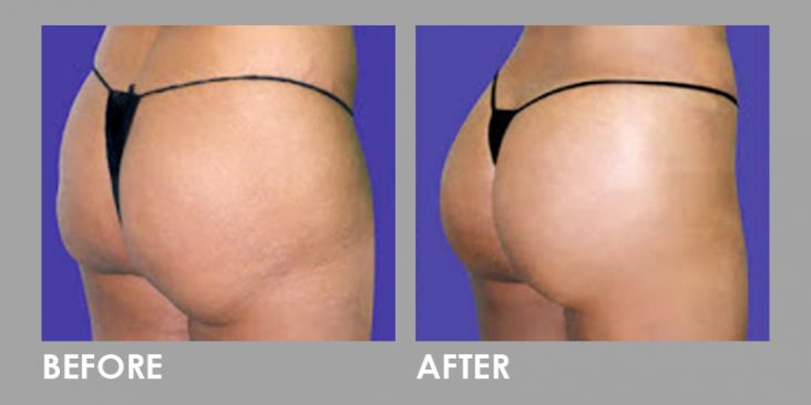 Before & After Buttock Injection Augmentation Procedure