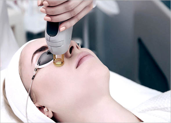 CANDELA GENTLE YAG LASER TREATMENT