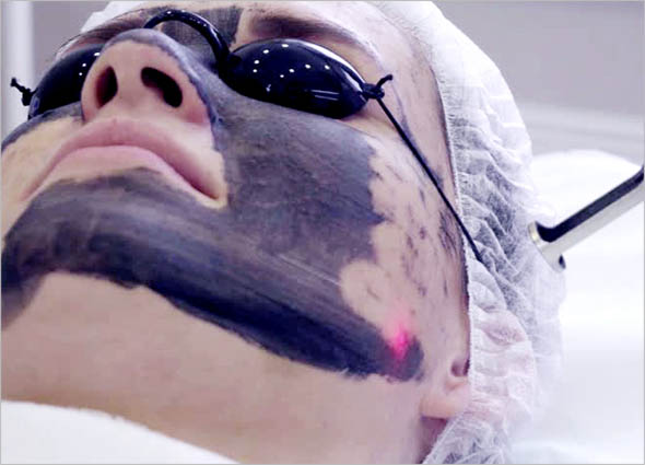 Carbon Laser Peel Treatment