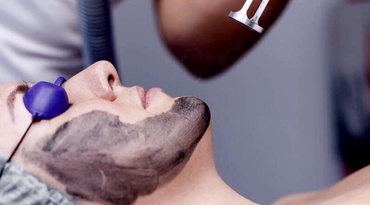 Carbon Laser Peel Treatment