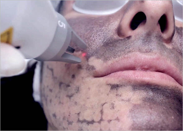 Carbon Laser Peel Treatment