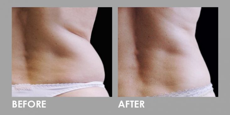 Before & After Clatuu Fat Freezing Treatment