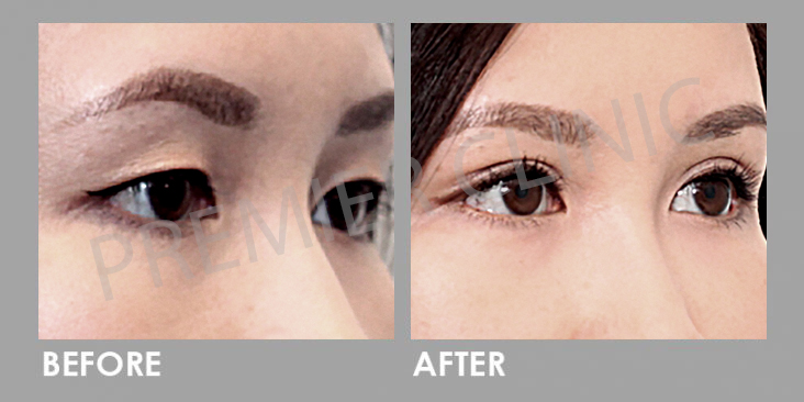 Before & After Double Eyelid Stitching