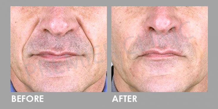 Before & After Dermal Filler Treatment