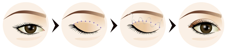 Double Eyelid Non-Invasive Surgery