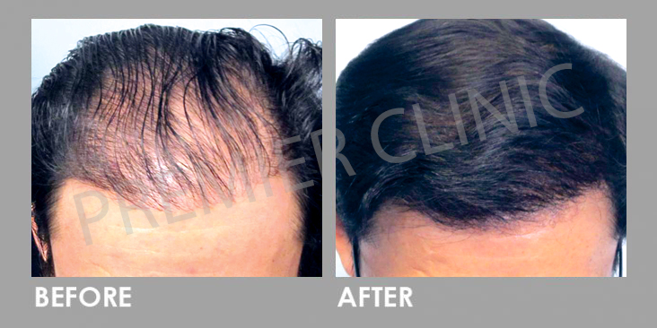 Before & After FUE Hair Transplant for Hair Loss