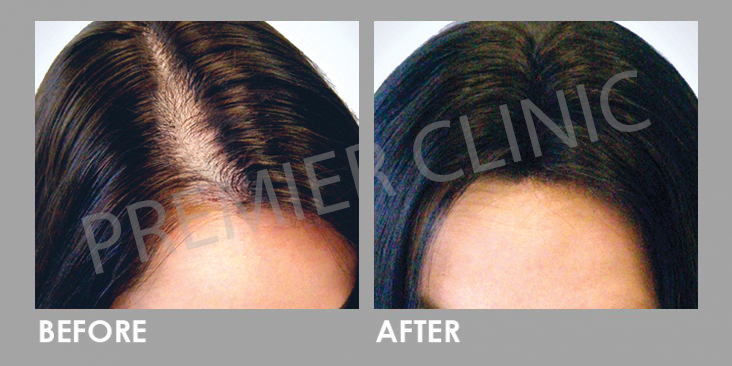 Before & After FUE Hair Transplant for Hair Loss
