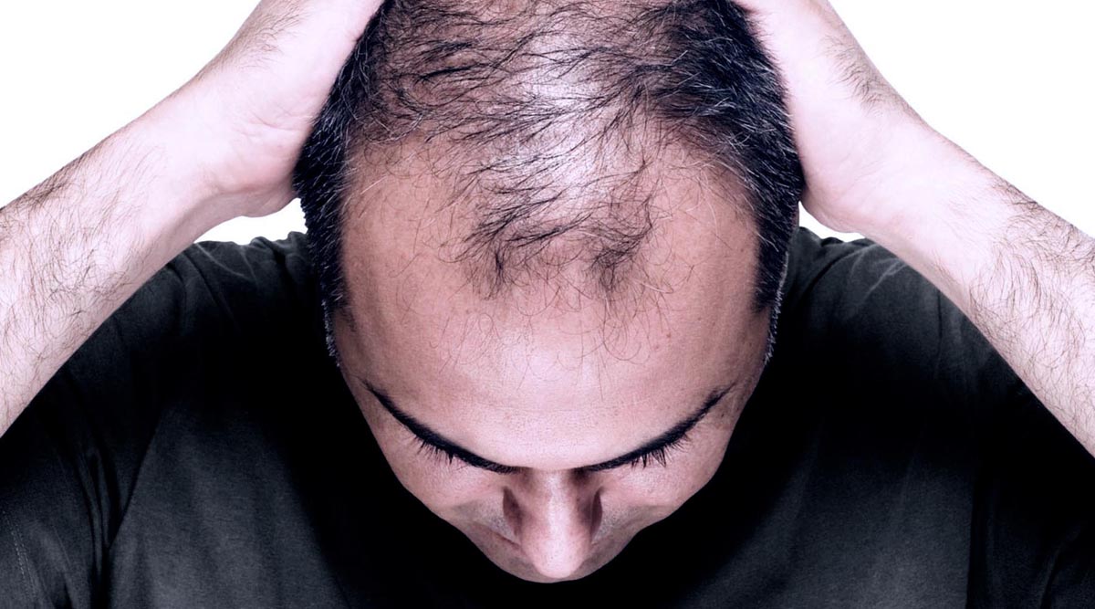 FUE Hair Transplant for Hair Loss