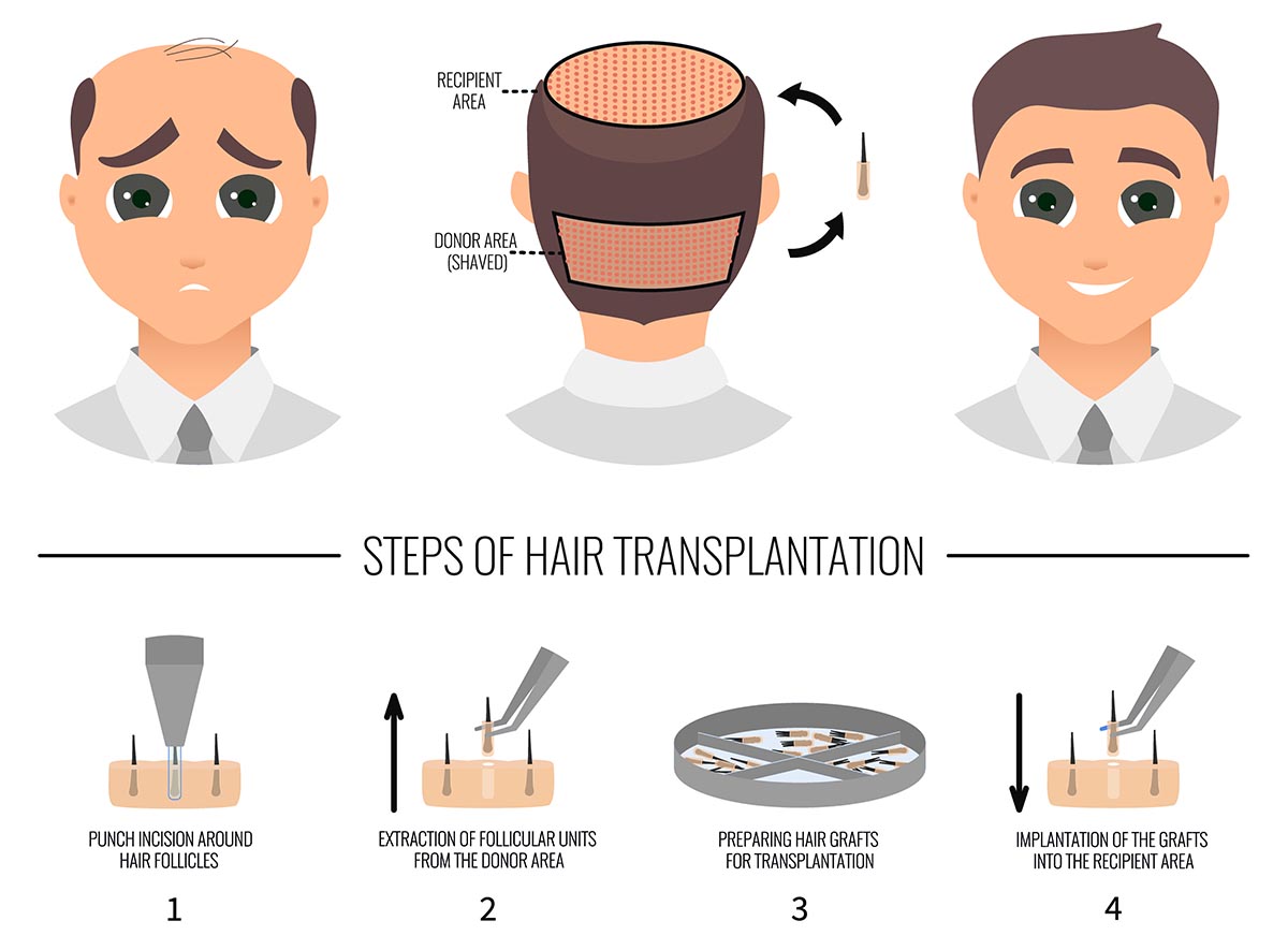 FUE Hair Transplant for Hair Loss - Premier Clinic