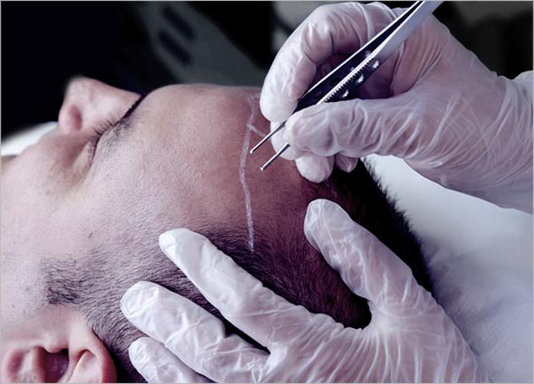 FUE Hair Transplant for Hair Loss