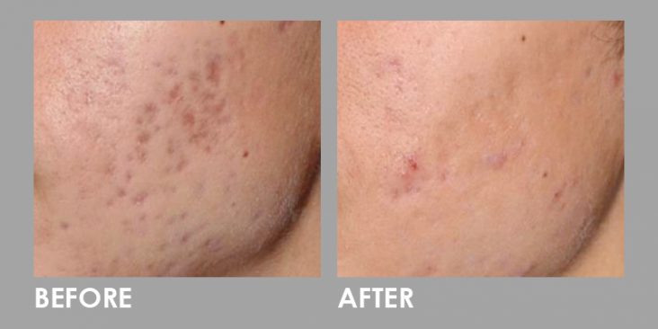 Before & After Fractional CO2 Laser Treatment
