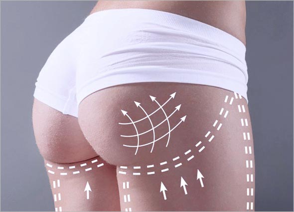 How does the Buttocks Augmentation work