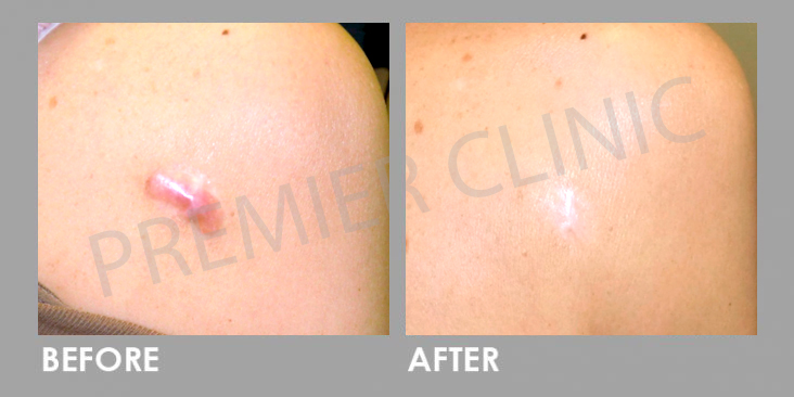 Before Keloid Scar Treatment & Removal