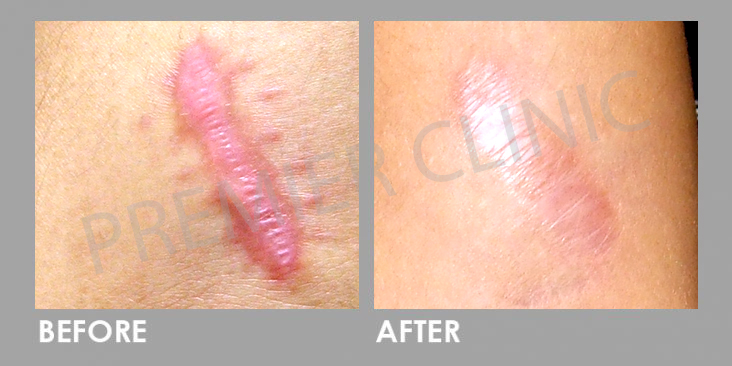 Before Keloid Scar Treatment & Removal