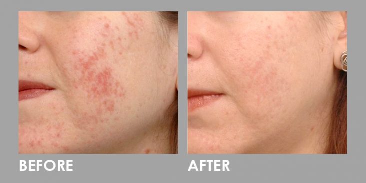 Before & After LED Photomodulation Therapy
