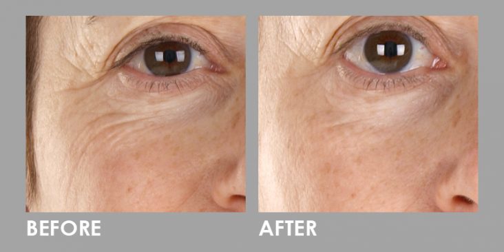 Before & After LED Photomodulation Therapy