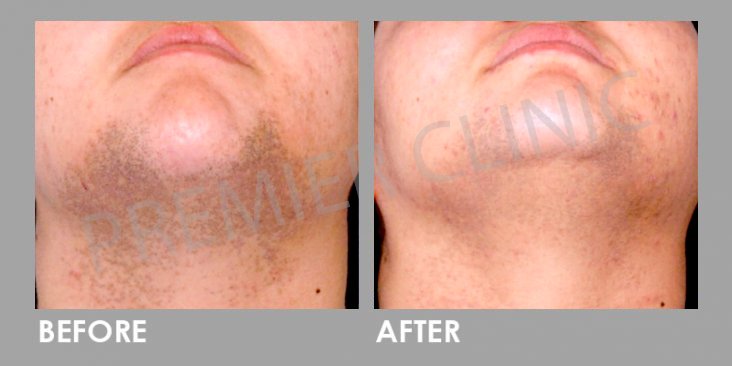 Before & After Candela Gentle YAG Laser Treatment