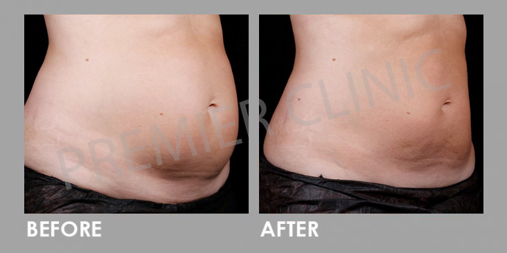 Before & After Le Shape: Weight Loss Body Slimming