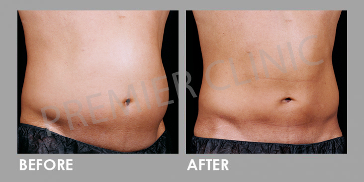 Before & After Le Shape: Weight Loss Body Slimming