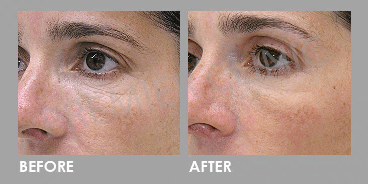 Premier Ultherapy For Under Eye Problems  Premier Clinic