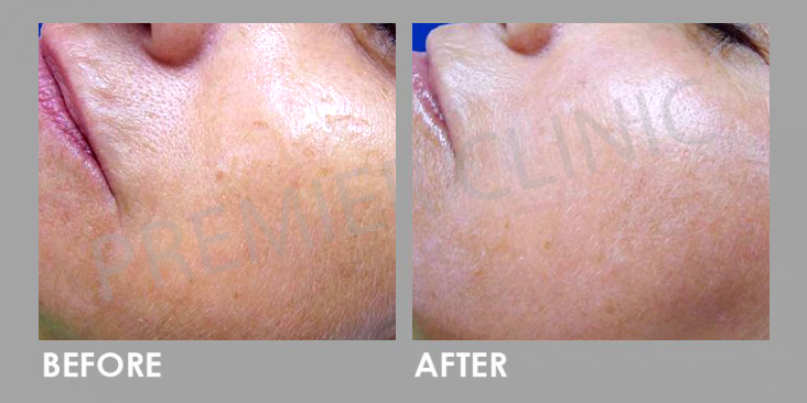 Before & After Mesotherapy