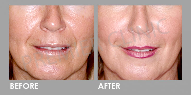 Before & After Mesotherapy