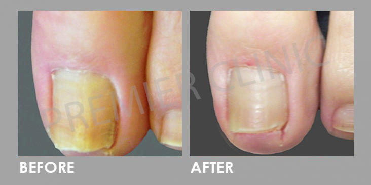 Before & After Nail Fungal Infection Laser