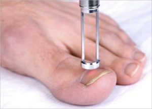 Nail Fungal Infection Laser 