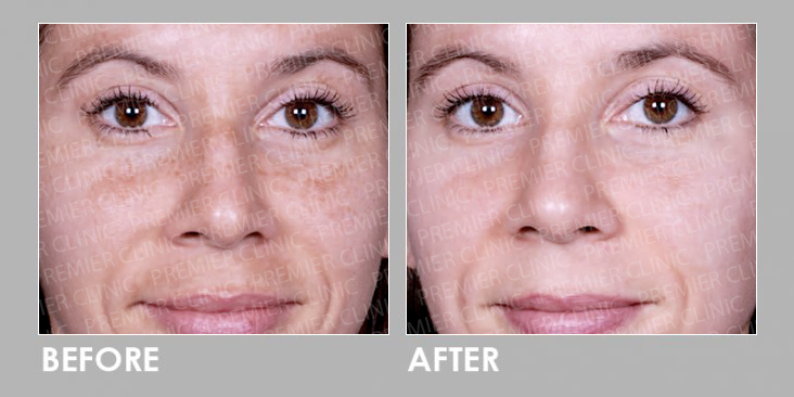 Before & After Obagi Medical Grade Skincare