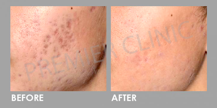 Before & After PICO Laser