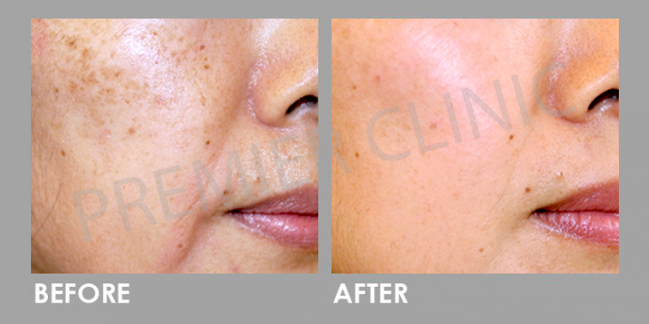Before & After PICO Laser