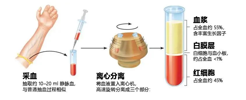 PRP 治疗步骤