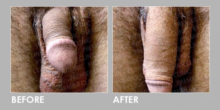 Penis Enlargement Treatment Before After