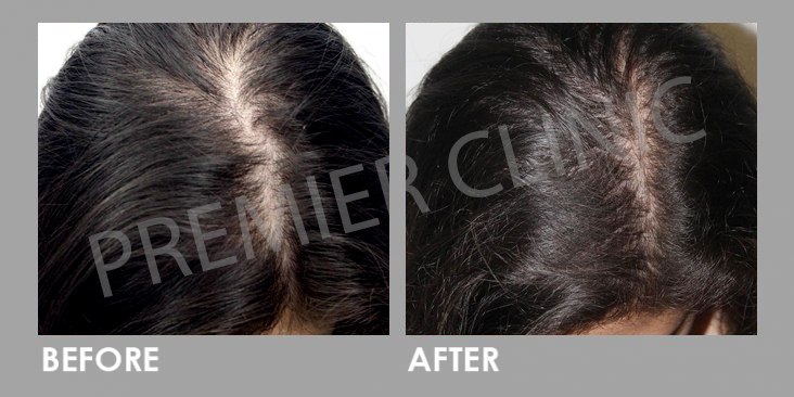 Before & After Premier Signature Hair Growth Laser