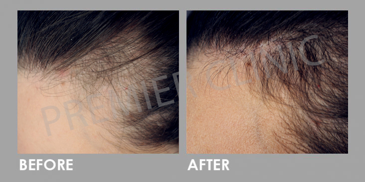 Before & After Premier Signature Hair Growth Laser