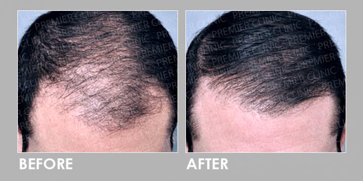 Before & After Finasteride Oral & Regro Spray