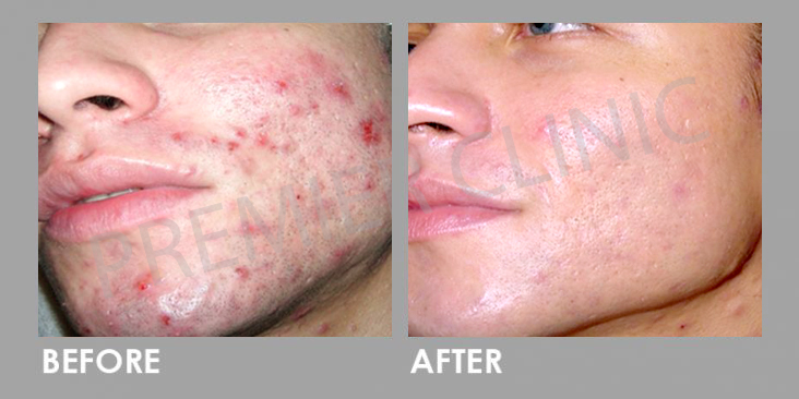 Before & After Silkpeel Dermalinfusion