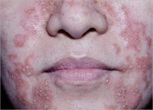 Skin Fungal Infection Laser 
