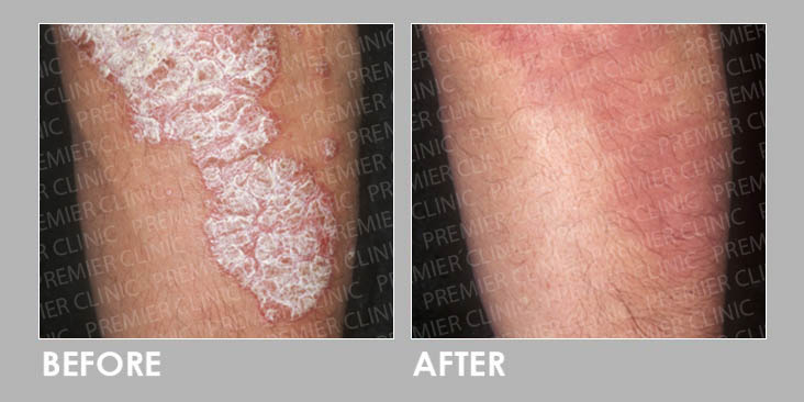 Before & After Skin Fungal Infection Laser
