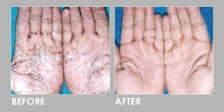 Before & After Skin Fungal Infection Laser