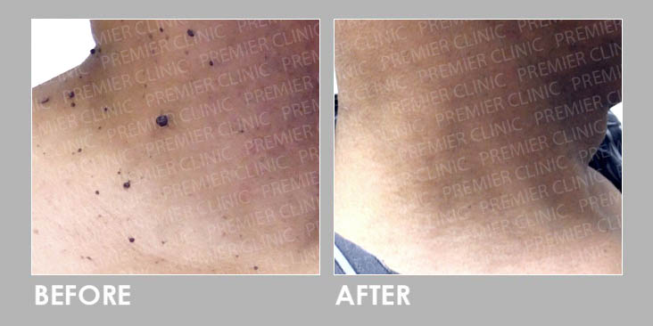 Skin Tag Removal Before After