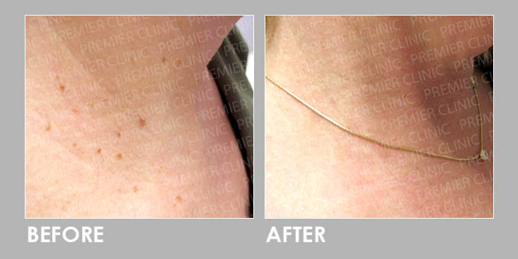 Skin Tag Removal Before After