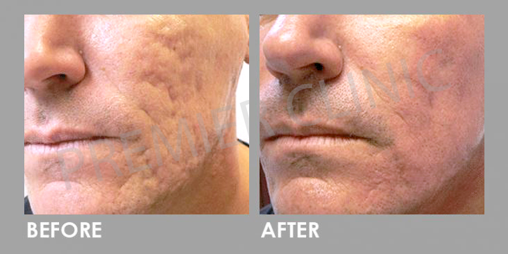 Before & After Subcision Skin Resurfacing Treatment