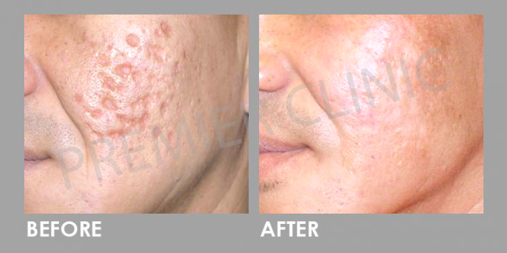 Before & After Subcision Skin Resurfacing Treatment
