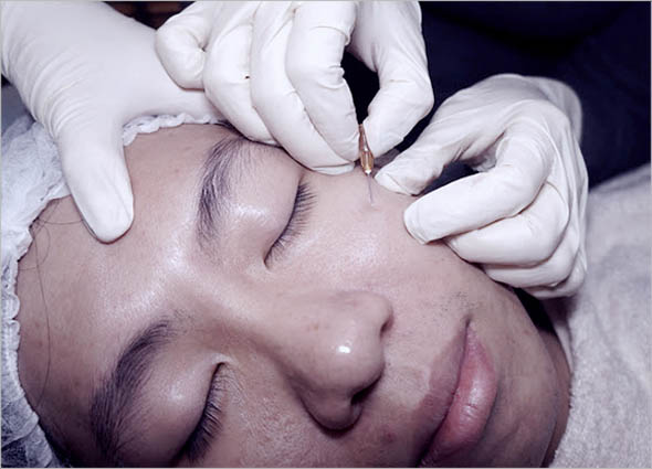 Subcision Skin Resurfacing Treatment