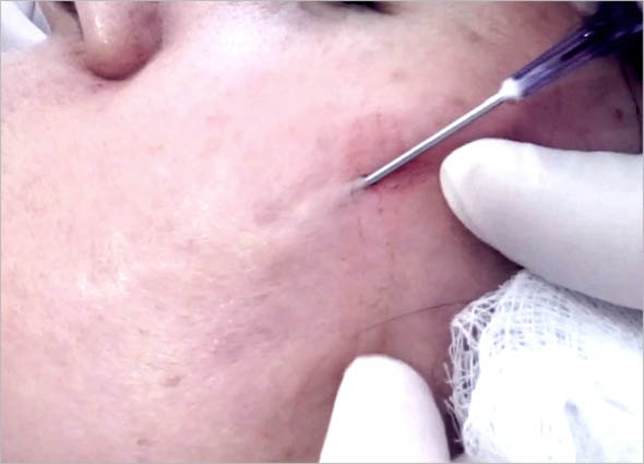 Subcision Skin Resurfacing Treatment