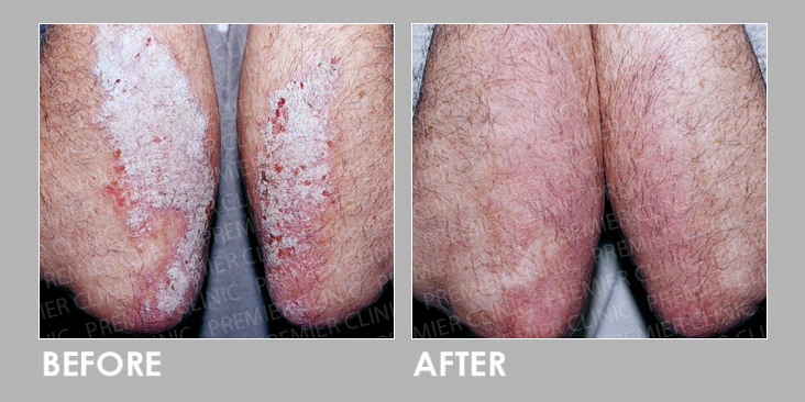 UVB Therapy Before & After