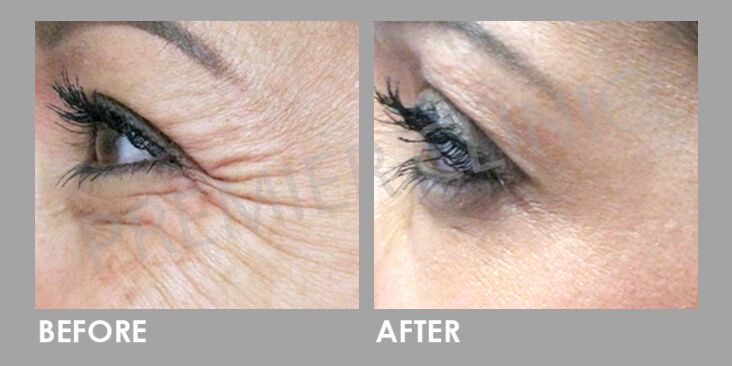 Premier Ultherapy For Saggy Skin