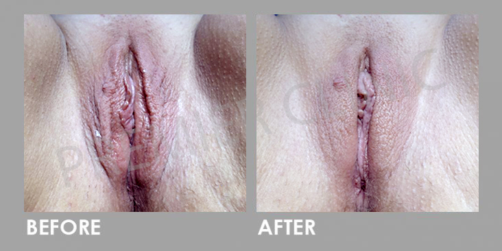 Female Genitals Skin Whitening Laser Treatment